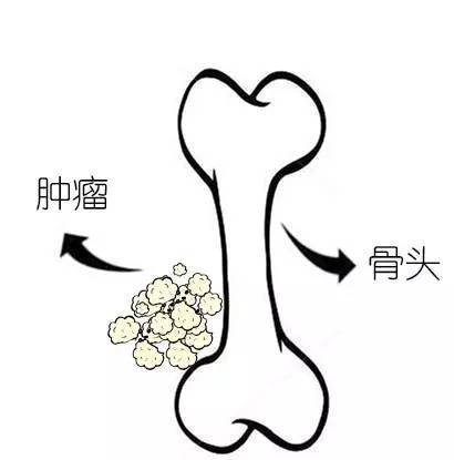 骨肿瘤的聚焦超声消融手术治疗