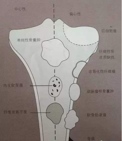 骨肿瘤是什么病，症状有哪些？