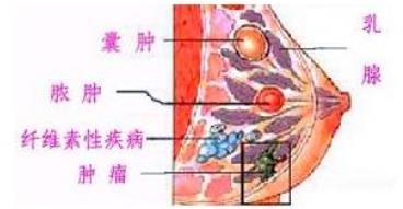 乳腺癌的症状有哪些？如何治疗？