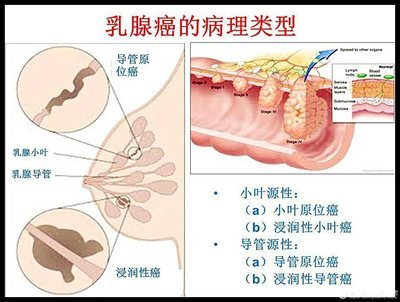 胰腺癌容易发生在老年人身上，其中大多数发生在60岁以上的人群中