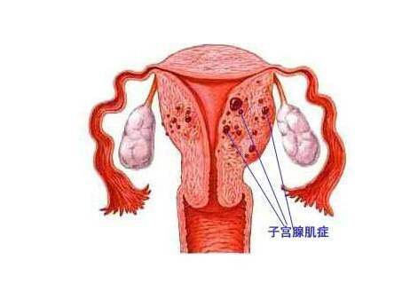 子宫肌瘤是一种激素依赖性肿瘤