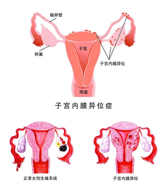 子宫内膜异位症