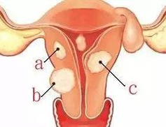 疼痛 一般情况下子宫肌瘤不引起疼痛