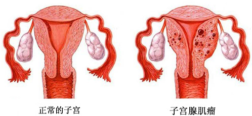 子宫腺肌病的聚焦超声消融手术治疗