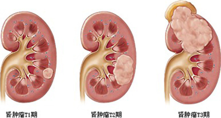 有吸烟习惯的人患胰腺癌的可能性是不吸烟的人的2至3倍