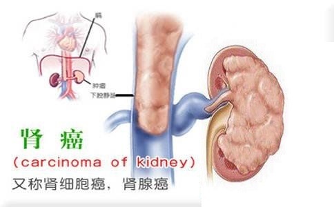 糖尿病患者患胰腺癌的可能性更大