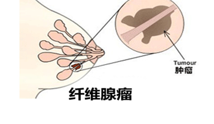 聚焦超声消融手术治疗乳腺纤维瘤