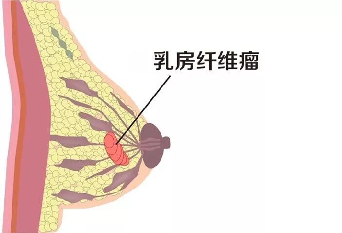什么是乳腺纤维瘤？